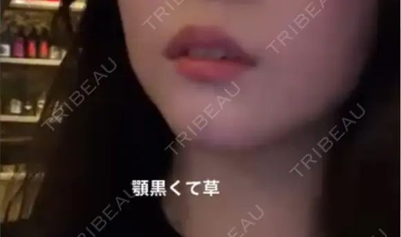 ボトックス（あご） / ヒアルロン酸注入（あご） / ボトックス（エラ・小顔） TCB東京中央美容外科 静岡院 DAY 0 メイン用