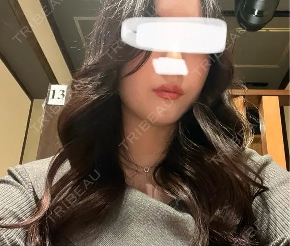 ボトックス（あご） / ヒアルロン酸注入（あご） / ボトックス（エラ・小顔） TCB東京中央美容外科 静岡院 DAY 7 メイン用