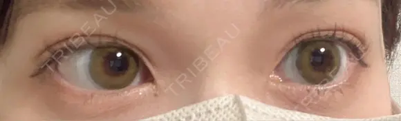 二重埋没 アリエル美容クリニック 横浜院 DAY 3 メイン用