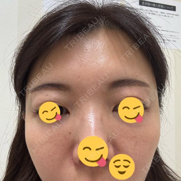 ボトックス（目尻） TCB東京中央美容外科 町田院 DAY 1 メイン用