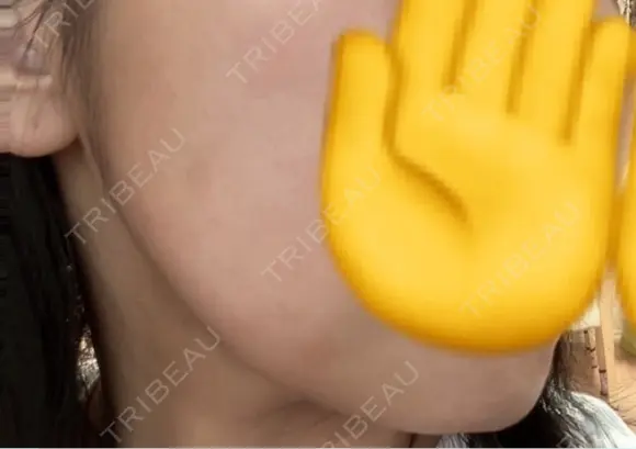 ボトックス（エラ・小顔） 日本ウェルネス再生クリニック AFTER メイン用