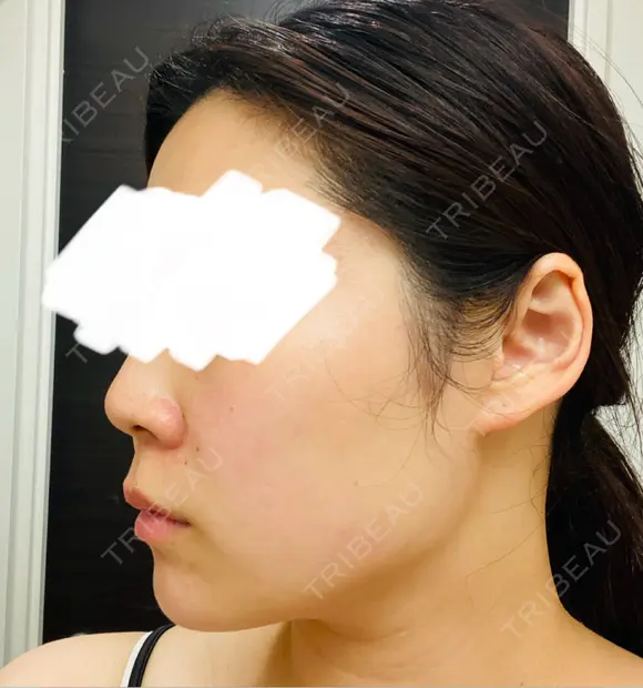 脂肪吸引（顔） / 脂肪吸引（二の腕） Mods Clinic（モッズクリニック） 福岡院 DAY 183 メイン用