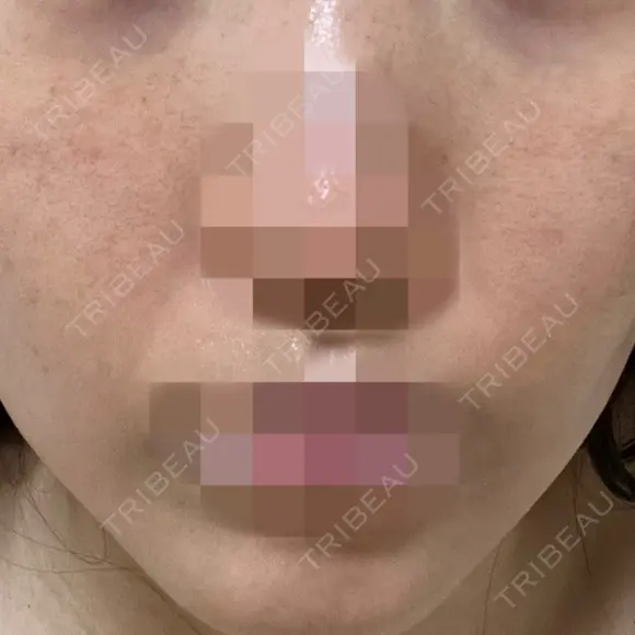 ポテンツァ ルラ美容クリニック 岡山院 DAY 7 メイン用