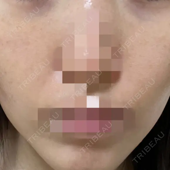 ポテンツァ ルラ美容クリニック 岡山院 DAY 8 メイン用