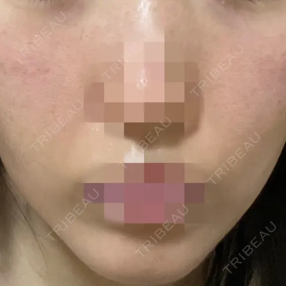 ポテンツァ ルラ美容クリニック 岡山院 DAY 9 メイン用