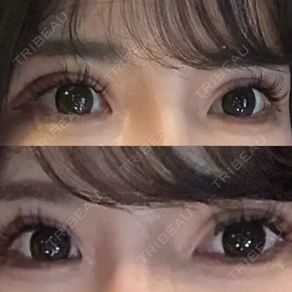 二重切開 / 眼瞼下垂（切開） / その他（目元） / 目尻切開 / タレ目形成・グラマラスライン（切開） オーキッド美容クリニック東京御徒町 DAY 56 メイン用