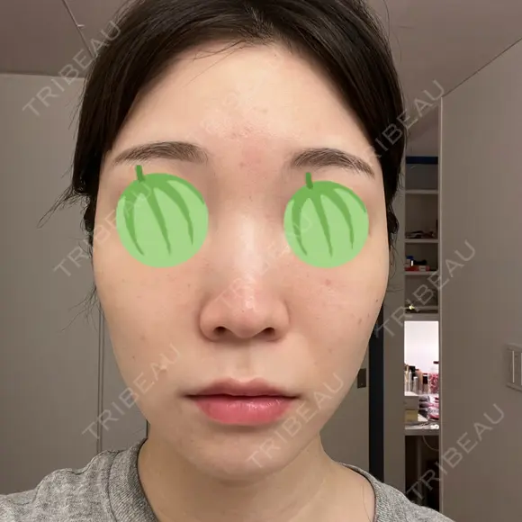 エレクトロポレーション / ピコレーザートーニング（美白・肝斑） 東京美容クリニック 表参道本院 DAY 1 メイン用