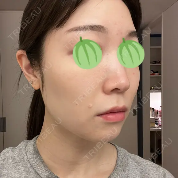 エレクトロポレーション / ピコレーザートーニング（美白・肝斑） 東京美容クリニック 表参道本院 DAY 1 メイン用