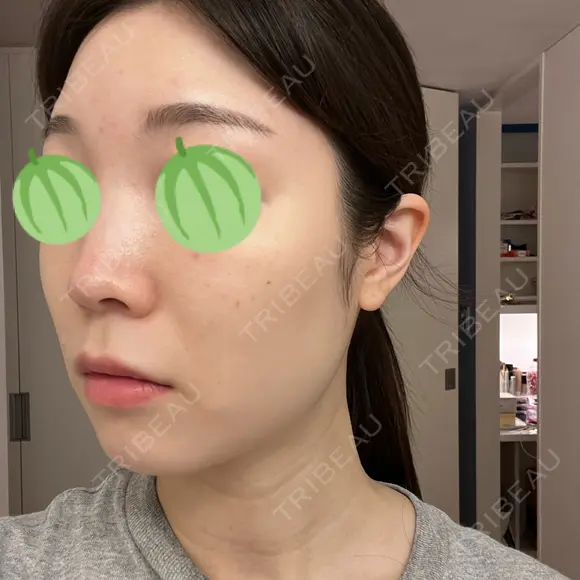 エレクトロポレーション / ピコレーザートーニング（美白・肝斑） 東京美容クリニック 表参道本院 DAY 1 メイン用