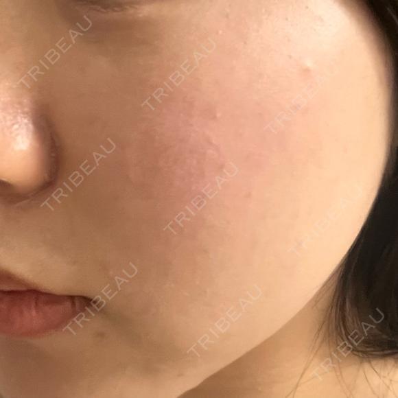 ピーリング（ハリ・ツヤ） / ルメッカ PureMe Skin Clinic（ピュアミースキンクリニック麻布） AFTER メイン用