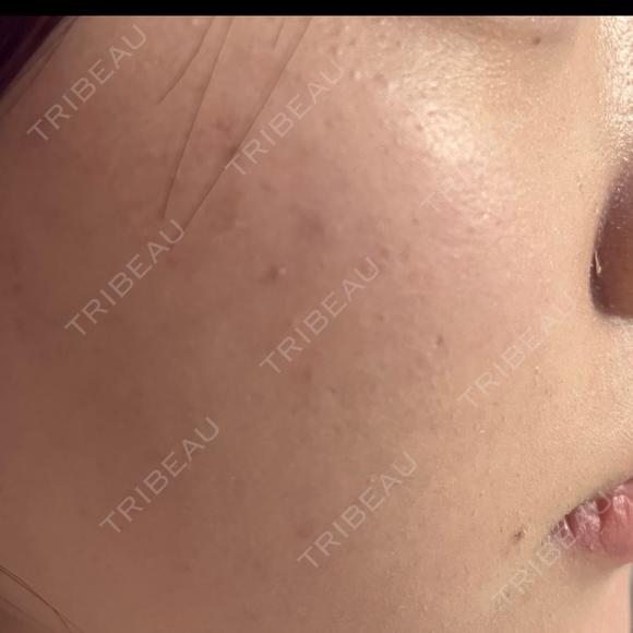 ピーリング（ハリ・ツヤ） / ルメッカ PureMe Skin Clinic（ピュアミースキンクリニック麻布） DAY 3 メイン用