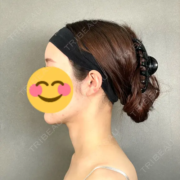 糸リフト / バッカルファット除去 / 脂肪吸引（顔） / ボトックス（エラ・小顔） アリエル美容クリニック 大宮院 DAY 189 メイン用
