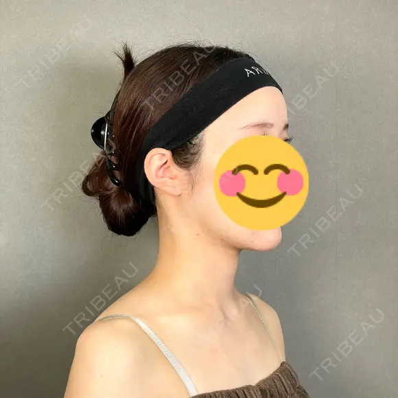 糸リフト / バッカルファット除去 / 脂肪吸引（顔） / ボトックス（エラ・小顔） アリエル美容クリニック 大宮院 DAY 189 メイン用