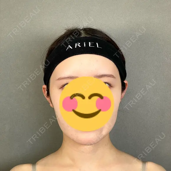 糸リフト / バッカルファット除去 / 脂肪吸引（顔） / ボトックス（エラ・小顔） アリエル美容クリニック 大宮院 AFTER メイン用