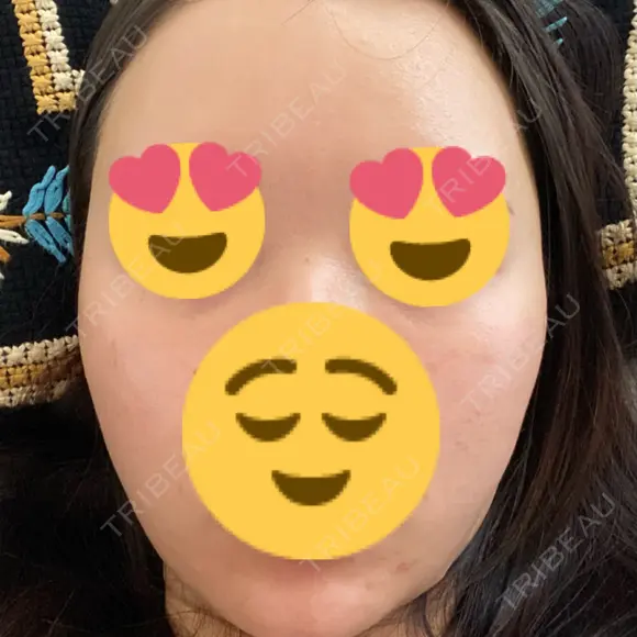 額を丸く / 下まぶたの脂肪取り / 脂肪注入（額） / 脂肪注入（目の下） イテウォンビューティークリニック 名古屋栄院 DAY 13 メイン用