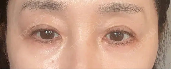二重埋没 LOCHIC CLINIC GINZA【ロシッククリニック銀座】 DAY 2 メイン用