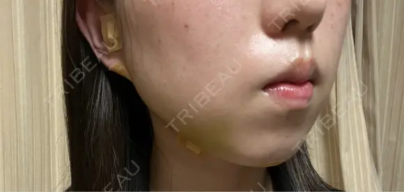 糸リフト / バッカルファット除去 / 脂肪吸引（顔） / ジョールファット除去 / ボトックス（エラ・小顔） アリエル美容クリニック 郡山院 DAY 20 メイン用