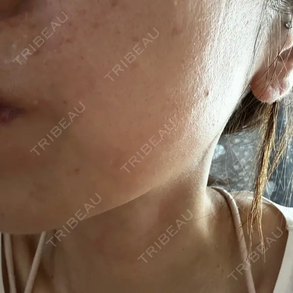 水光注射（ハリ・美肌） しんゆり美容健康クリニック DAY 1 メイン用