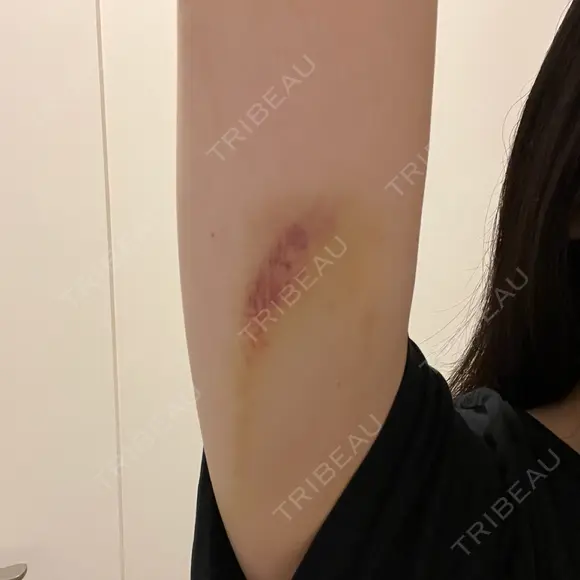 脂肪溶解注射（二の腕） ルラ美容クリニック 大阪心斎橋院 DAY 6 メイン用