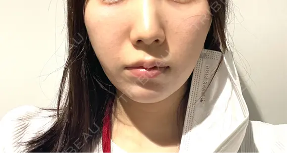 脂肪溶解注射（顔） Nクリニック伏見 DAY 2 メイン用