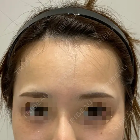 骨切り（あご） / ボトックス（口角） / ヒアルロン酸注入（こめかみ） DMTC CLINIC 渋谷院 AFTER メイン用
