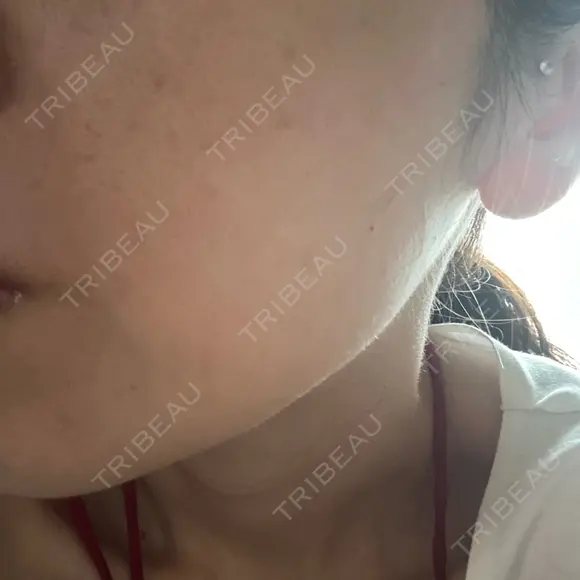 水光注射（ハリ・美肌） しんゆり美容健康クリニック AFTER メイン用