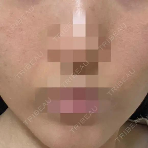 ポテンツァ ルラ美容クリニック 岡山院 DAY 10 メイン用