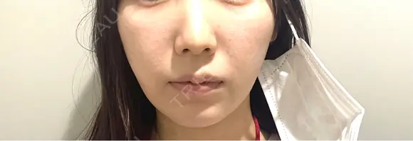 脂肪溶解注射（顔） Nクリニック伏見 DAY 3 メイン用