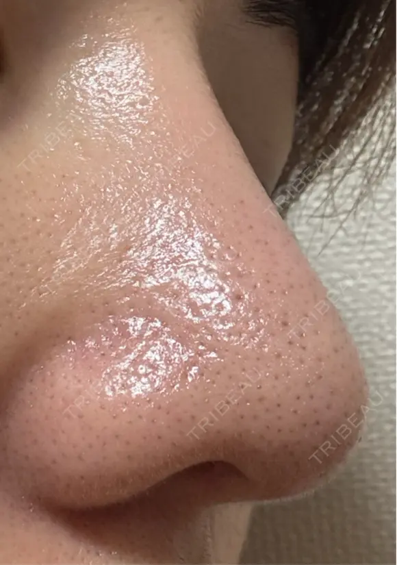 毛穴洗浄（ハイドラフェイシャルなど） 美容皮膚科エルムクリニック 福岡院 DAY 7 メイン用