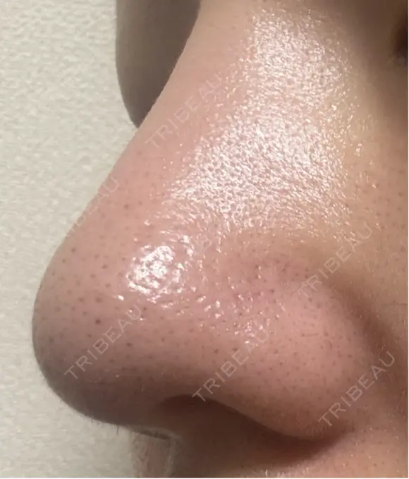 毛穴洗浄（ハイドラフェイシャルなど） 美容皮膚科エルムクリニック 福岡院 DAY 8 メイン用