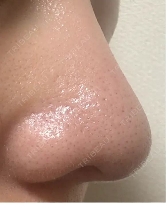 毛穴洗浄（ハイドラフェイシャルなど） 美容皮膚科エルムクリニック 福岡院 DAY 8 メイン用