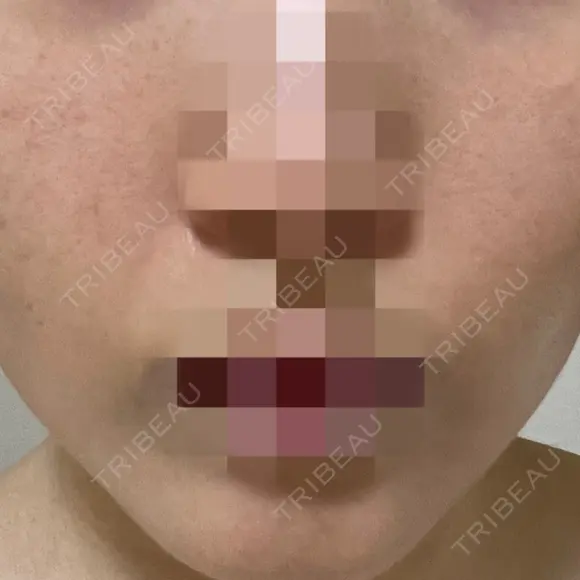 ポテンツァ ルラ美容クリニック 岡山院 AFTER メイン用