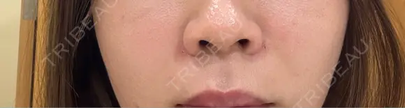 ヒアルロン酸注入（鼻翼基部） 大美会クリニック 梅田院 AFTER メイン用