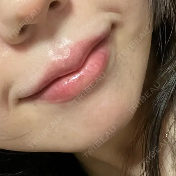 ヒアルロン酸注入（唇） / ボトックス（口角） ルラ美容クリニック 仙台院 / ルラスキンクリニック 仙台院 AFTER メイン用