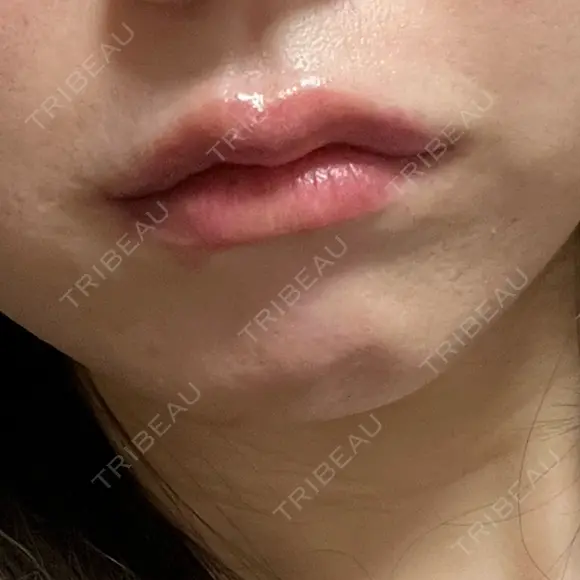 ヒアルロン酸注入（唇） / ボトックス（口角） ルラ美容クリニック 仙台院 / ルラスキンクリニック 仙台院 DAY 1 メイン用