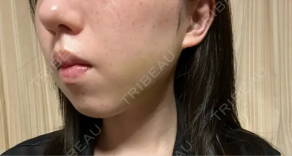 糸リフト / バッカルファット除去 / 脂肪吸引（顔） / ジョールファット除去 / ボトックス（エラ・小顔） アリエル美容クリニック 郡山院 DAY 22 メイン用