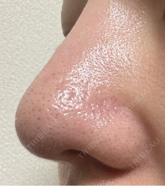 毛穴洗浄（ハイドラフェイシャルなど） 美容皮膚科エルムクリニック 福岡院 DAY 9 メイン用