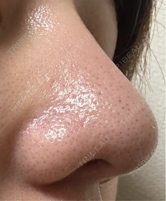 毛穴洗浄（ハイドラフェイシャルなど） 美容皮膚科エルムクリニック 福岡院 DAY 9 メイン用