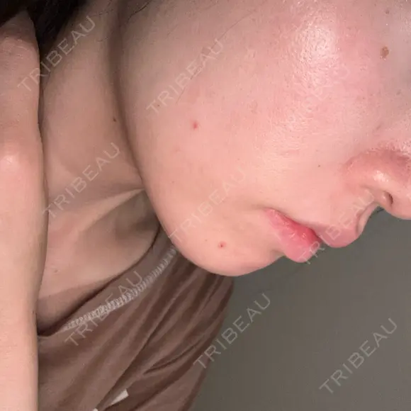 毛穴洗浄（ハイドラフェイシャルなど） MKクリニック 日本橋院 AFTER メイン用