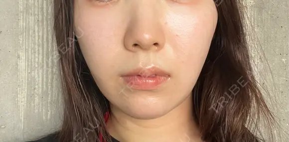 脂肪溶解注射（顔） Nクリニック伏見 DAY 4 メイン用