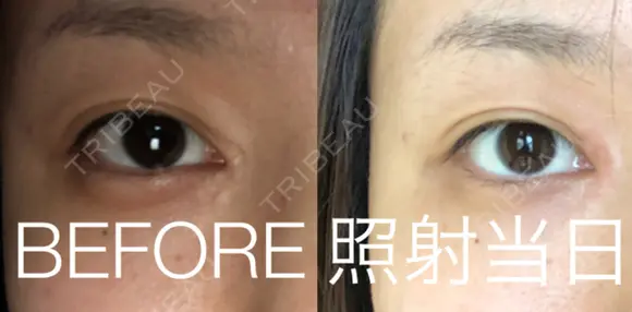 傷跡修正 / ほくろ・いぼ除去レーザー（肌） 山本クリニック DAY 0 メイン用