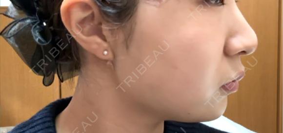 糸リフト アリエル美容クリニック 郡山院 DAY 0 メイン用
