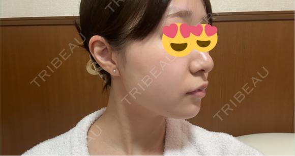 糸リフト アリエル美容クリニック 郡山院 AFTER メイン用