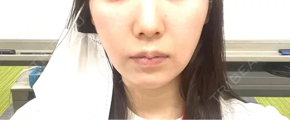 脂肪溶解注射（顔） Nクリニック伏見 DAY 5 メイン用