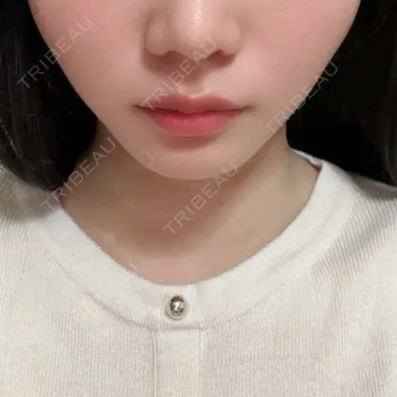 その他（輪郭） ルラ美容クリニック 沖縄院 AFTER メイン用