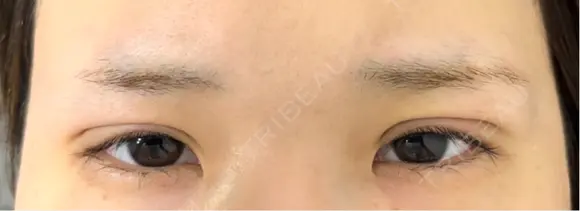 二重埋没 アリエル美容クリニック 郡山院 DAY 2 メイン用