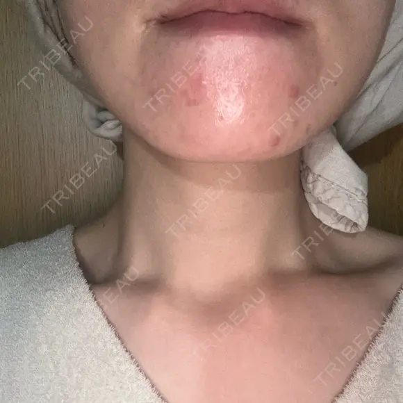 ピーリング（ニキビ・毛穴） / 光治療（フォトフェイシャルなど） RAISE CLINIC 【レイズクリニック】 AFTER メイン用