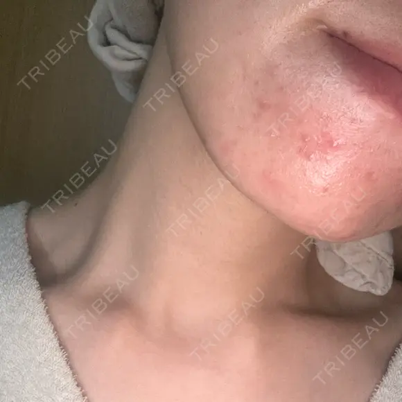 ピーリング（ニキビ・毛穴） / 光治療（フォトフェイシャルなど） RAISE CLINIC 【レイズクリニック】 DAY 219 メイン用