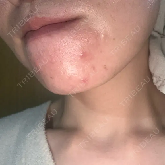 ピーリング（ニキビ・毛穴） / 光治療（フォトフェイシャルなど） RAISE CLINIC 【レイズクリニック】 DAY 219 メイン用