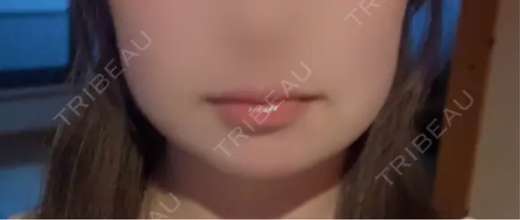 脂肪吸引（顔） ネビュラクリニック 京都院 DAY 4 メイン用